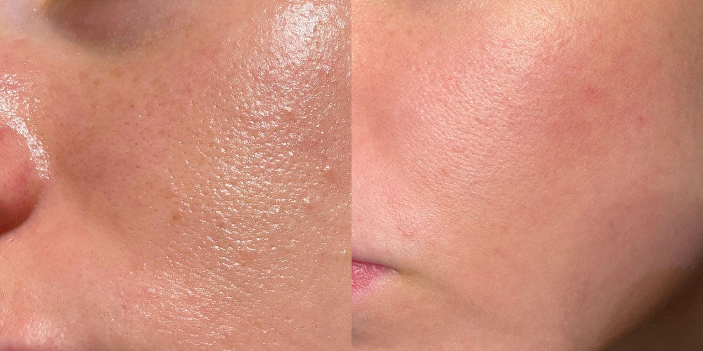 درمان جوش و اکنه