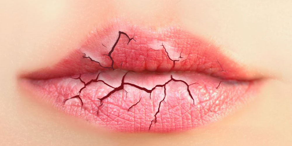 ترک و پوسته شدن لب