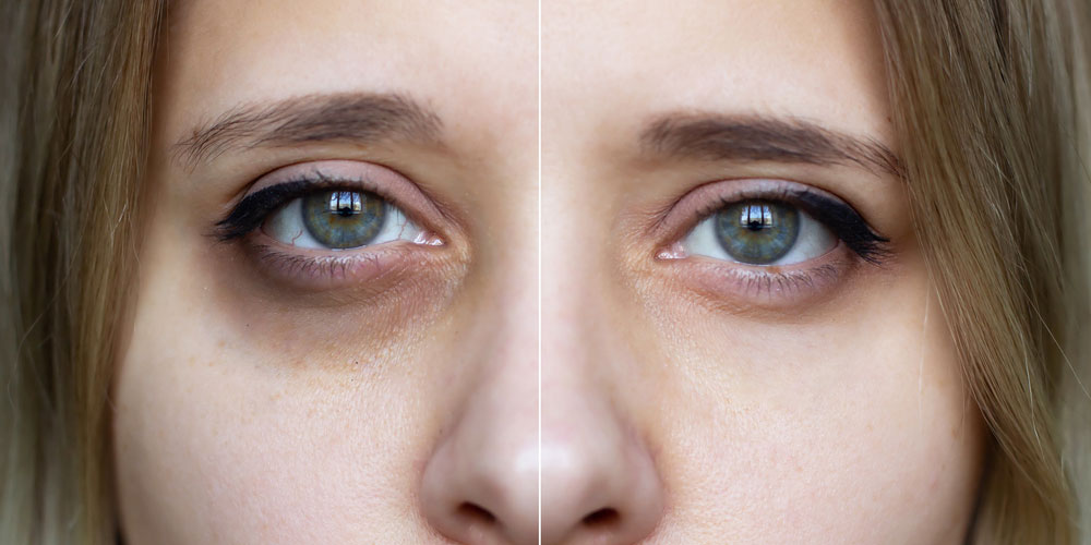 رفع تیرگی زیر چشم