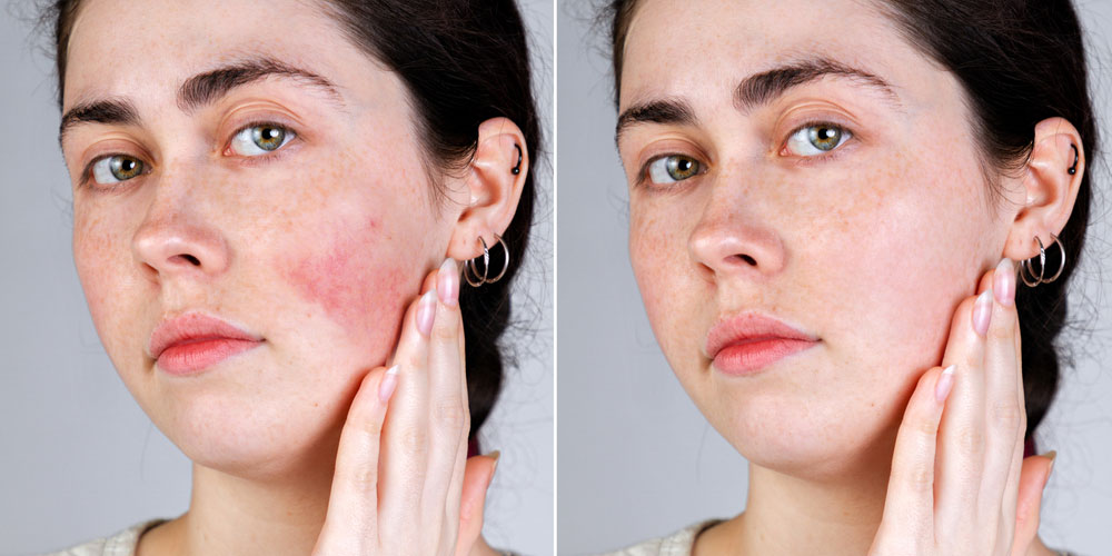 پوست حساس و ملتهب