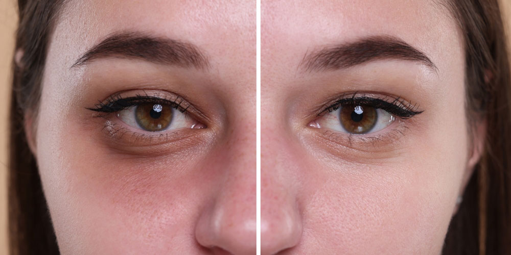 رفع تیرگی زیر چشم