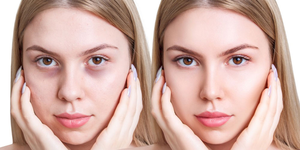 رفع تیرگی دور چشم