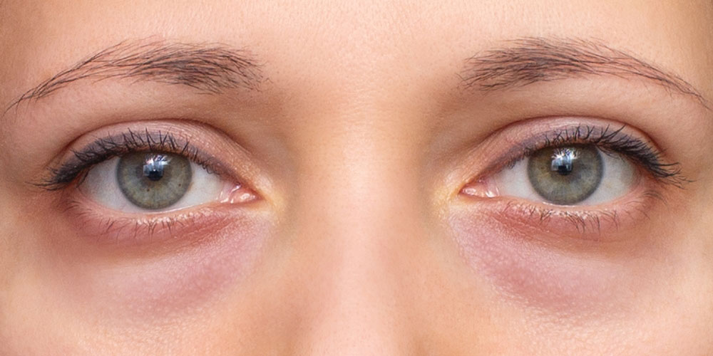 تیرگی زیر چشم