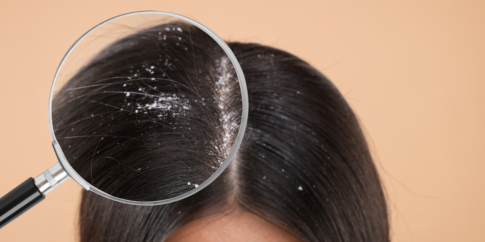 شامپو ضدشوره برای شوره شدید و پوست حساس