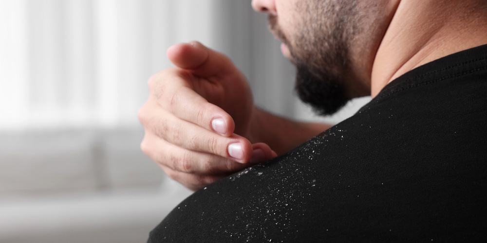 راهنمای جامع انتخاب بهترین شامپو ضد شوره