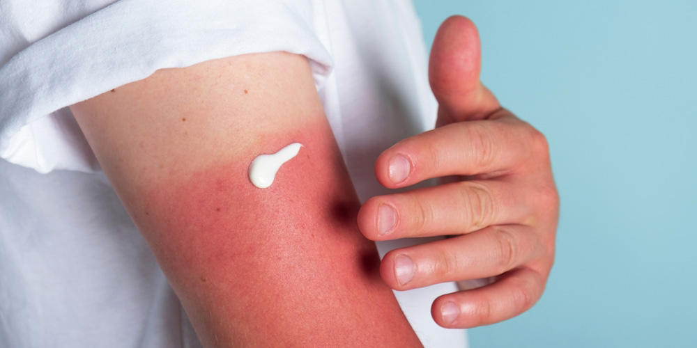 آفتاب سوختگی چیست و چرا اتفاق می‌افتد