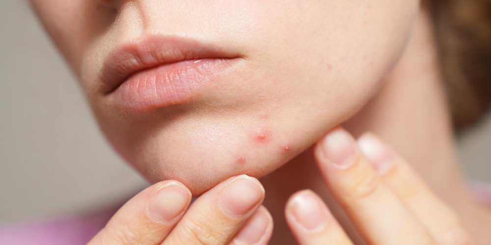 شایع‌ترین بیماری‌های پوستی و راه‌های درمان آن‌ها با محصولات بهداشتی