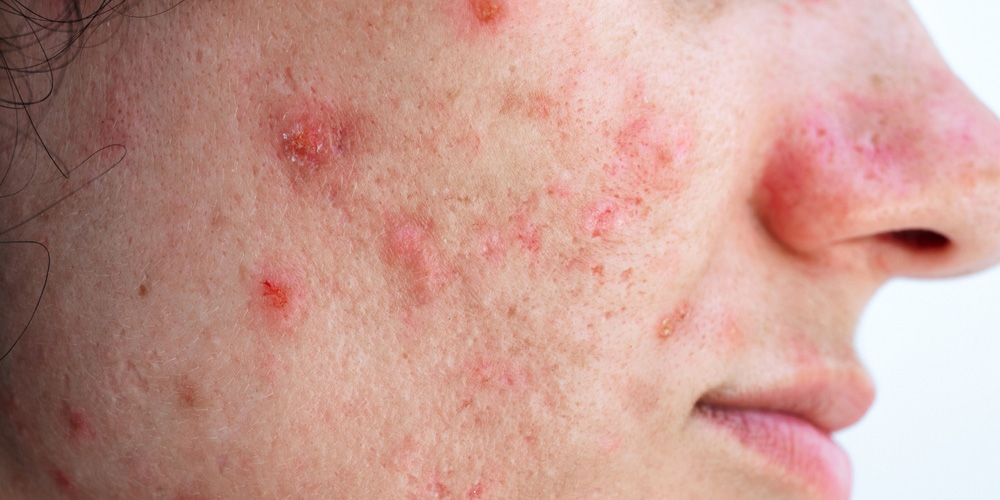 آکنه (جوش صورت)؛ شایع‌ترین اختلال پوستی التهابی