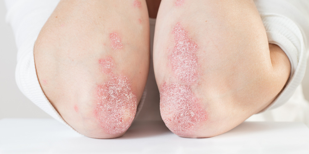 پسوریازیس؛ تکثیر سریع سلول‌های پوستی