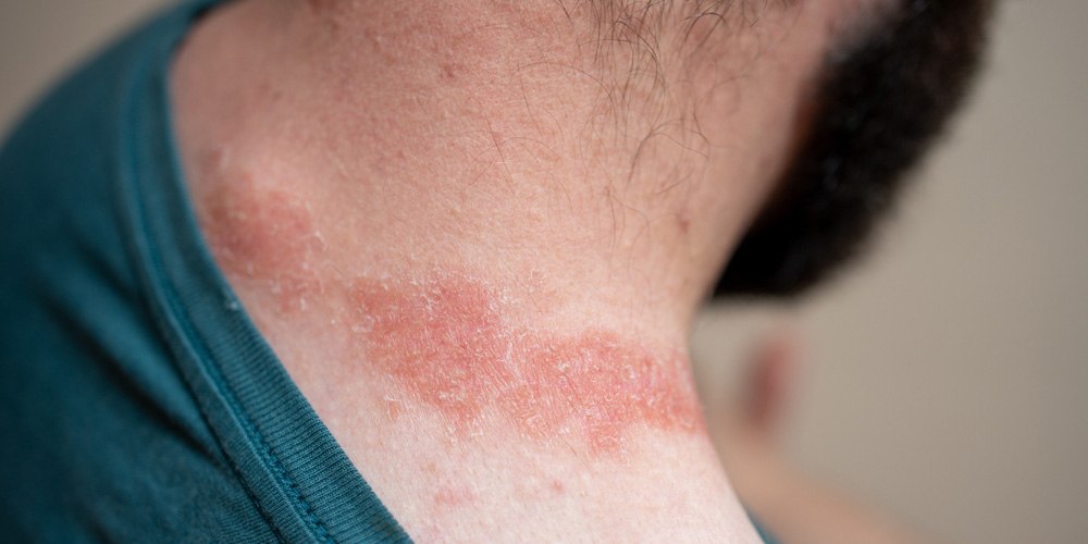 اگزما (درماتیت آتوپیک)؛ خشکی و التهاب مزمن