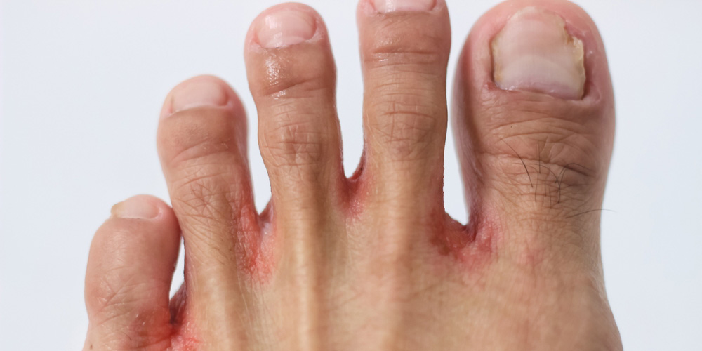 عفونت‌های قارچی؛ رشد قارچ در محیط‌های مرطوب